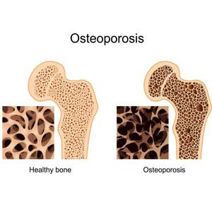 Treatment-for-osteoporosis-to-relieve-from-manopause-problems