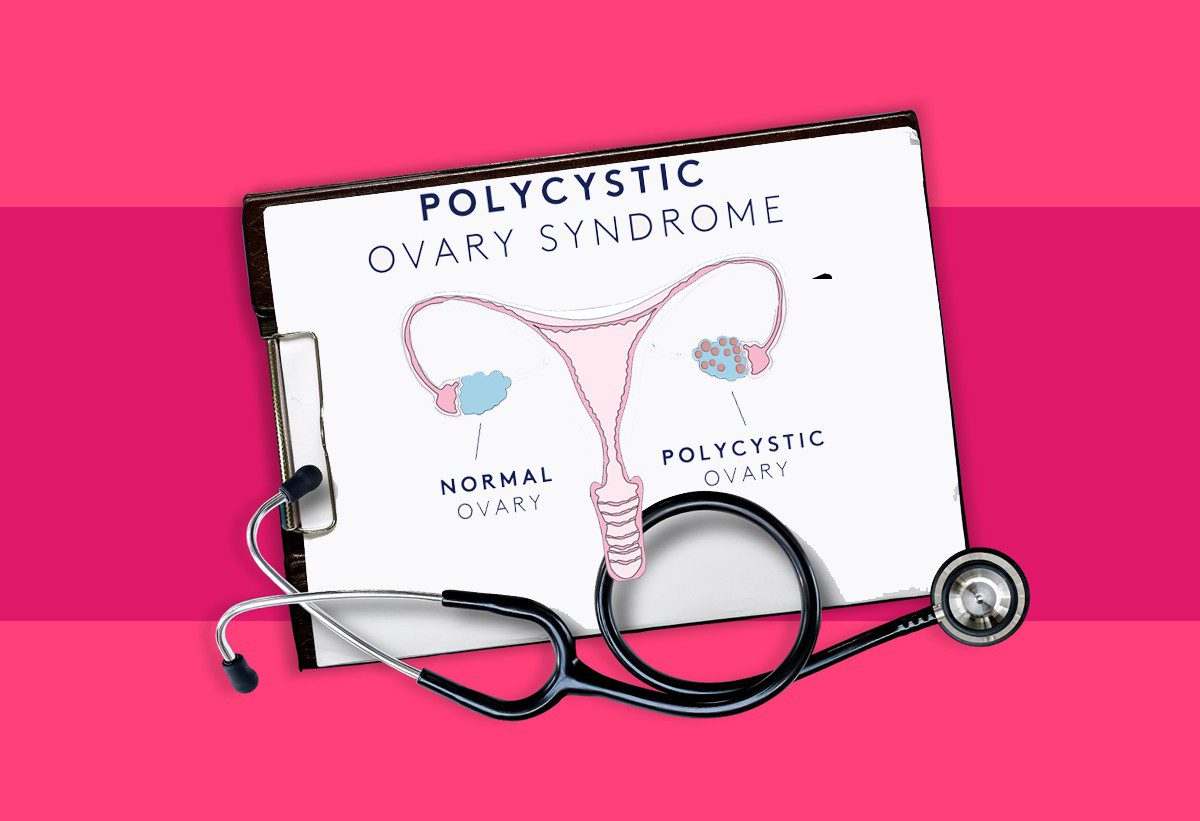 post-7-common-tips-to-cure-PCOS-naturally
